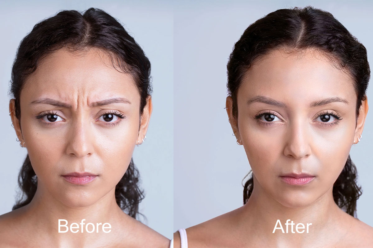 Xeomin in Chantilly, VA Flawless Skincare and Aesthetics